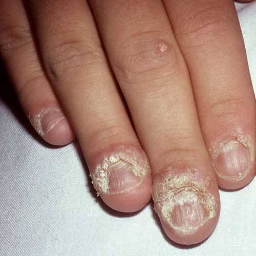 Wart On Fingers .............Treatment and Prevention
